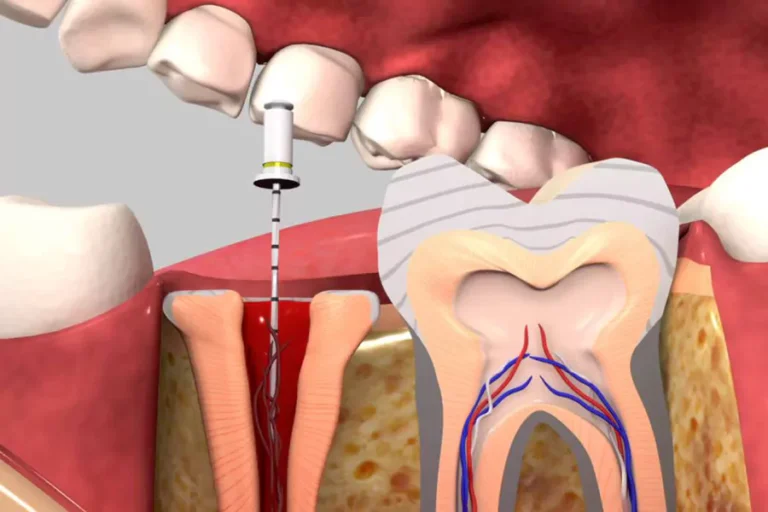 درمان مجدد ریشه